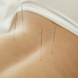 acupuncture treatment Cambridge