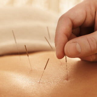 Acupuncture needles for fertility support in Cambridge, serving Hamilton.