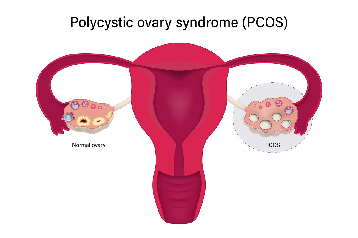 PCOS acupuncture Hamilton diagram of uterus and ovaries supporting fertility and hormonal balance.